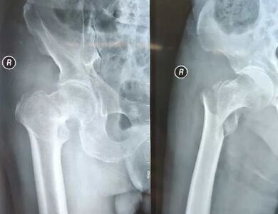 Real orthopedic surgical case using fixation implants