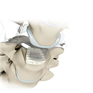 Orthopaedic Surgery Implants Corpectomy Cervical Interbody Fusion Cage Spine Cervical Cage PEEK