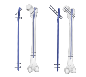 Expert Femoral Intramedullary Nail Orthopedic Implant