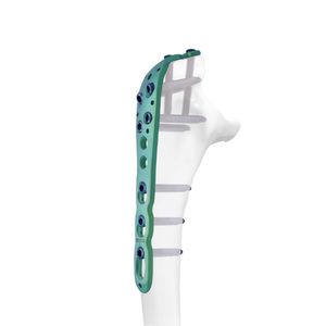 Discounted Price Orthopedic Implants Titanium LCP Olecranon Locking Plate